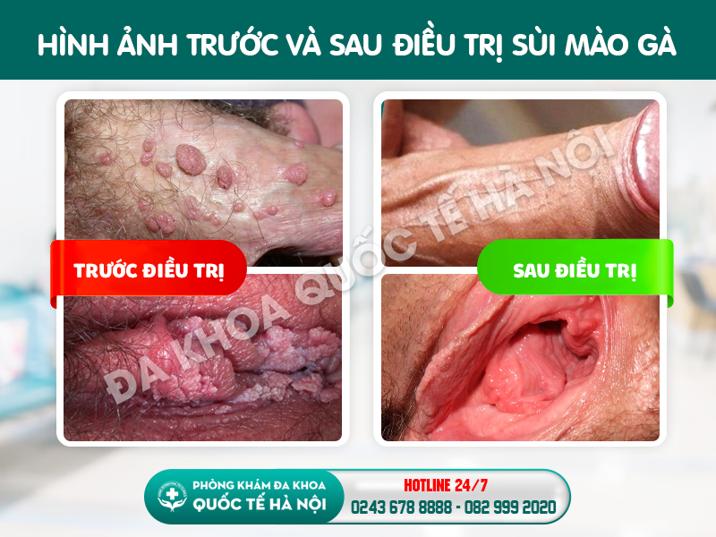 trước và sau điều trị sùi