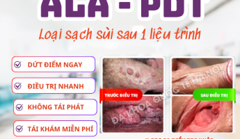 so-sanh-cac-phuong-phap-dieu-tri-sui-mao-ga-hien-nay