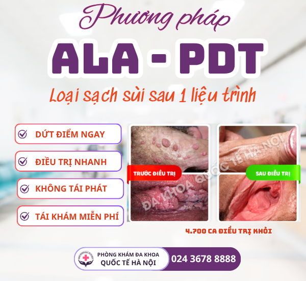 phương pháp ala pdt