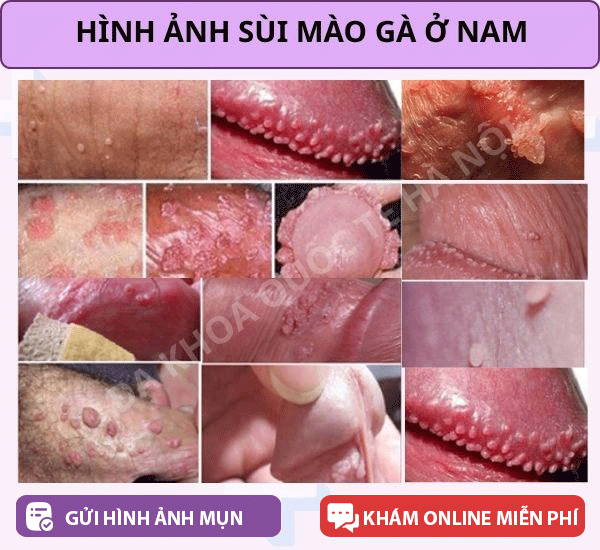 hình ảnh sùi mào gà ở nam