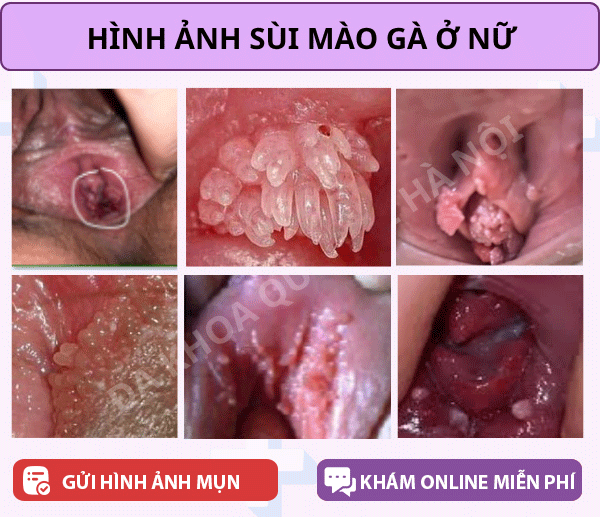 sùi mào gà ở nữ