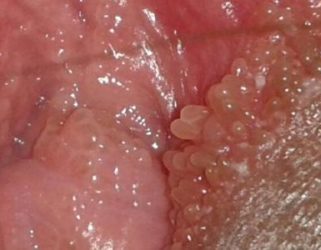 sùi mào gà ở nữ