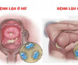di-tieu-buot-va-ra-mu-la-bi-benh-gi