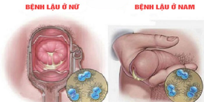 di-tieu-buot-va-ra-mu-la-bi-benh-gi