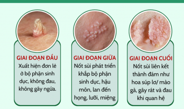 canh-bao-80-nguoi-bi-sui-mao-ga-deu-tung-chi-ngua-nhe-truoc-khi-phat-benh