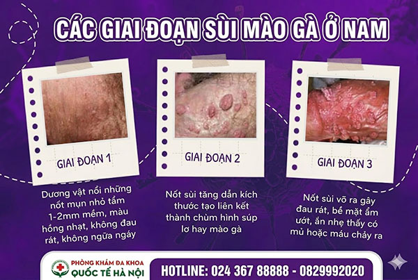 dấu hiệu sùi mào gà nam