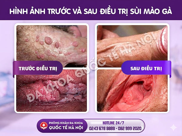 trước và sau khi điều trị sùi mào gà
